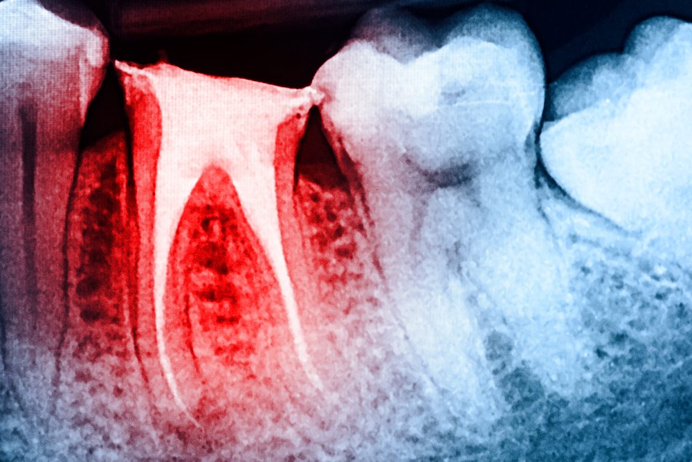 Apicoectomy » Milwaukee Endodontist Endodontics Wisconsin Endodontics